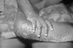 Affenpocken-Infektion bei einem vierjährigen Mädchen (Quelle: Centers for Disease Control and Prevention, USA)